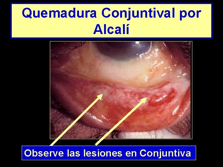 Quemadura Conjuntival por Alcalí Observe las lesiones en Conjuntiva 