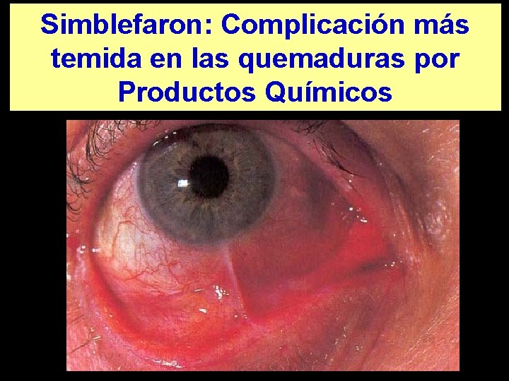 Simblefaron: Complicación más temida en las quemaduras por Productos Químicos 