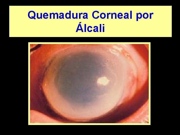 Quemadura Corneal por Álcali 