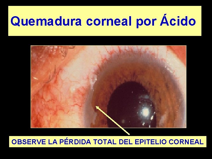 Quemadura corneal por Ácido OBSERVE LA PÉRDIDA TOTAL DEL EPITELIO CORNEAL 