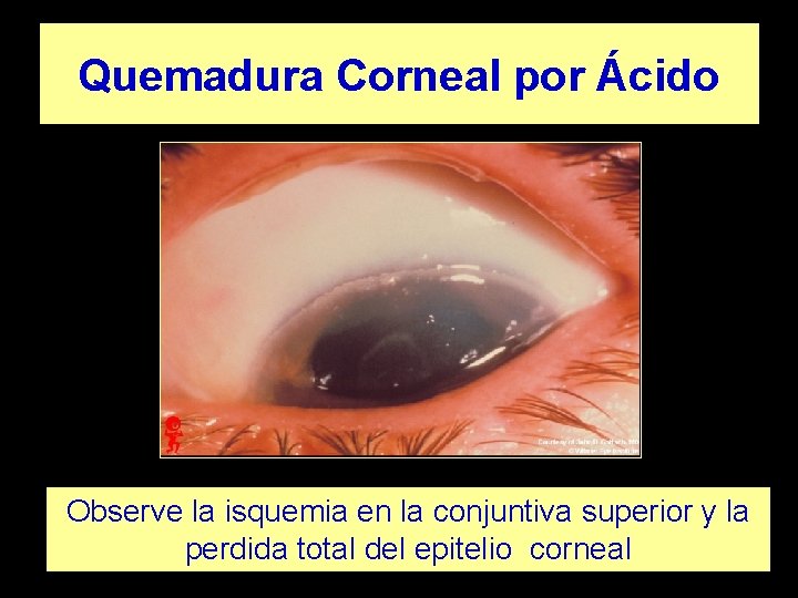Quemadura Corneal por Ácido Observe la isquemia en la conjuntiva superior y la perdida