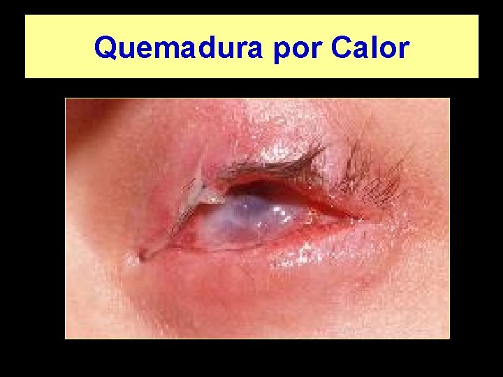 Quemadura por Calor 