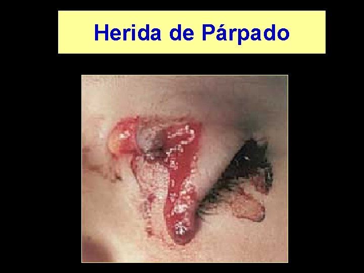 Herida de Párpado 