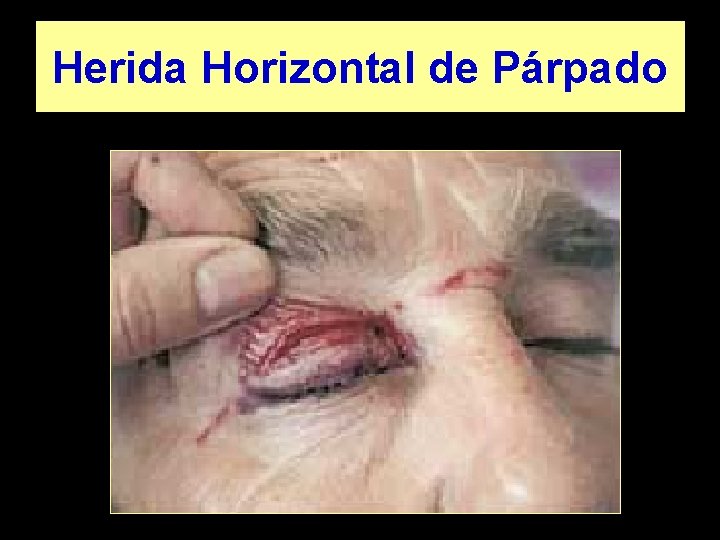 Herida Horizontal de Párpado 