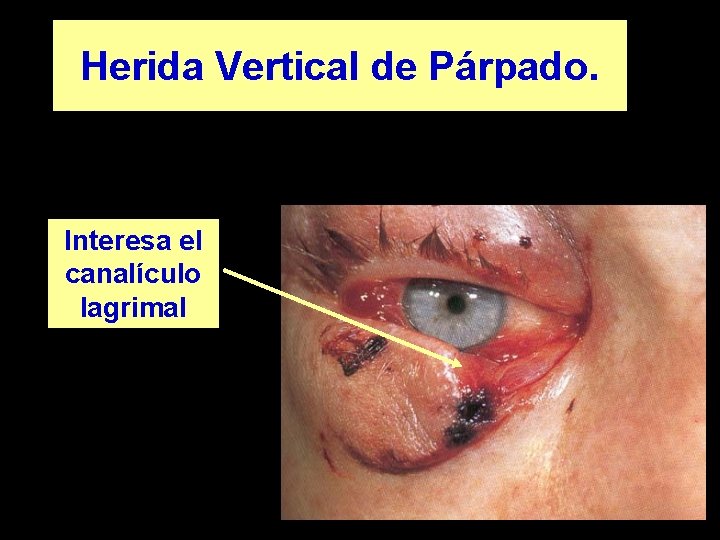Herida Vertical de Párpado. Interesa el canalículo lagrimal 