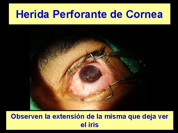 Herida Perforante de Cornea Observen la extensión de la misma que deja ver el