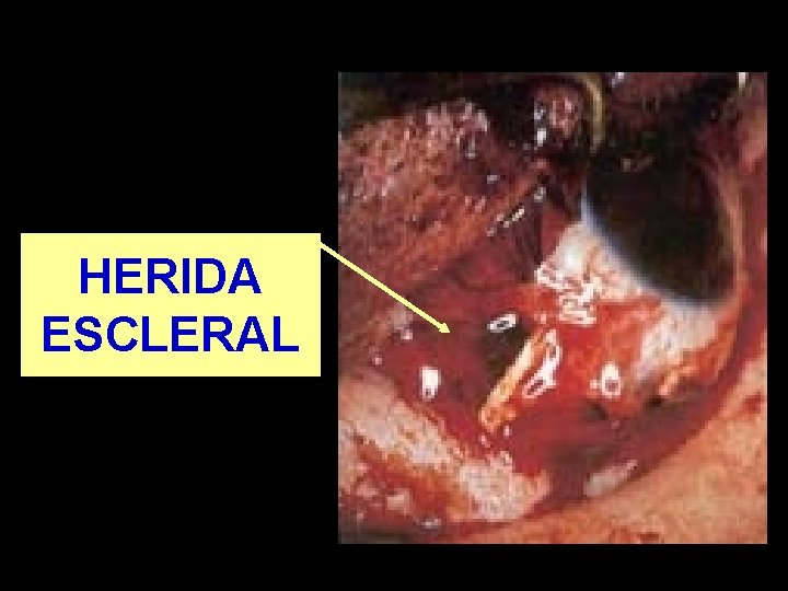 HERIDA ESCLERAL 