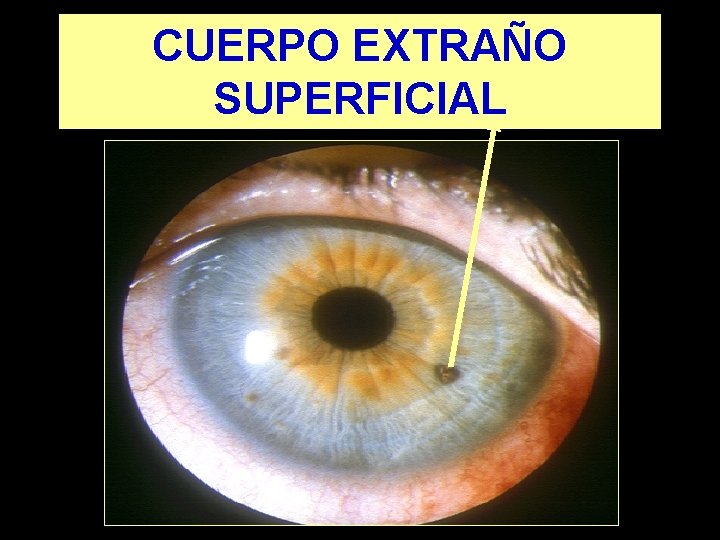 CUERPO EXTRAÑO SUPERFICIAL 