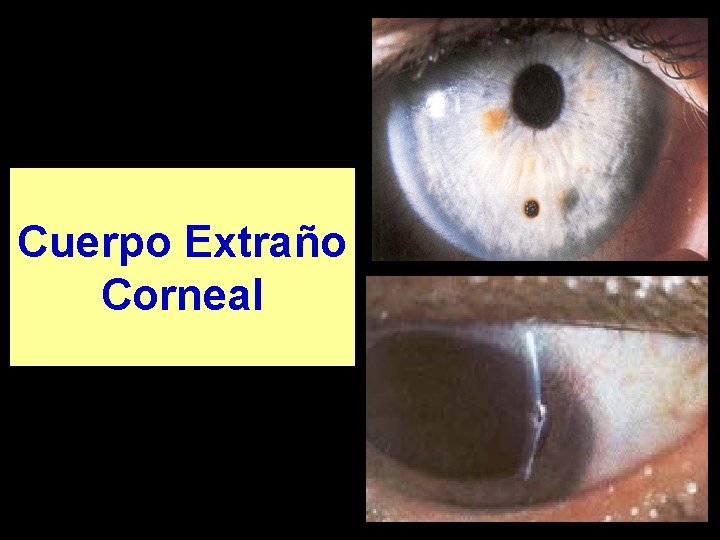 Cuerpo Extraño Corneal 