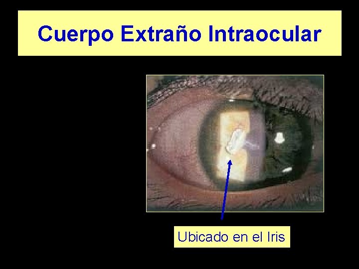 Cuerpo Extraño Intraocular Ubicado en el Iris 