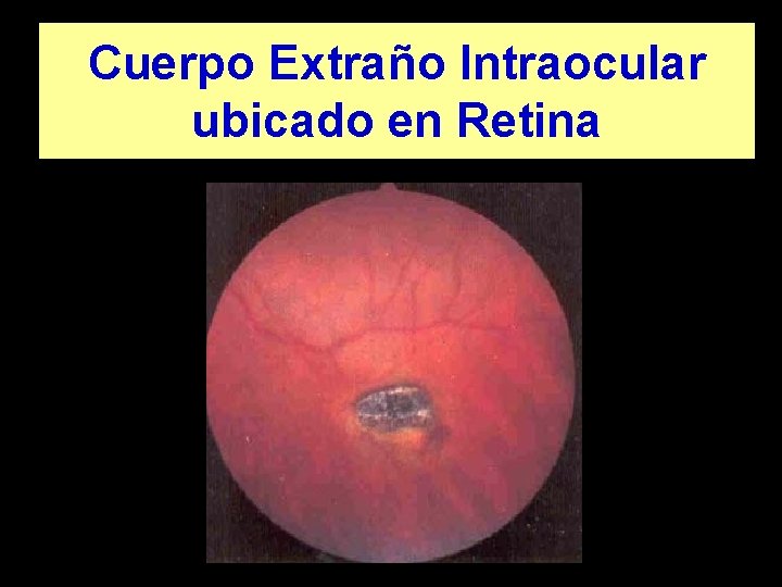 Cuerpo Extraño Intraocular ubicado en Retina 