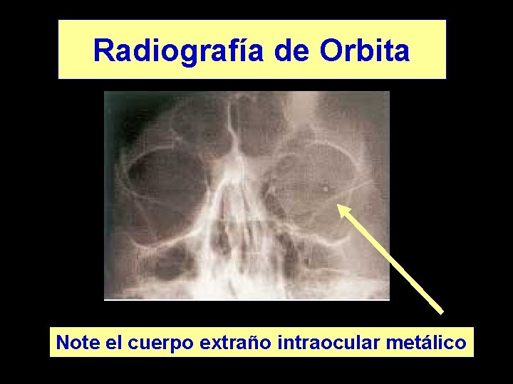 Radiografía de Orbita Note el cuerpo extraño intraocular metálico 