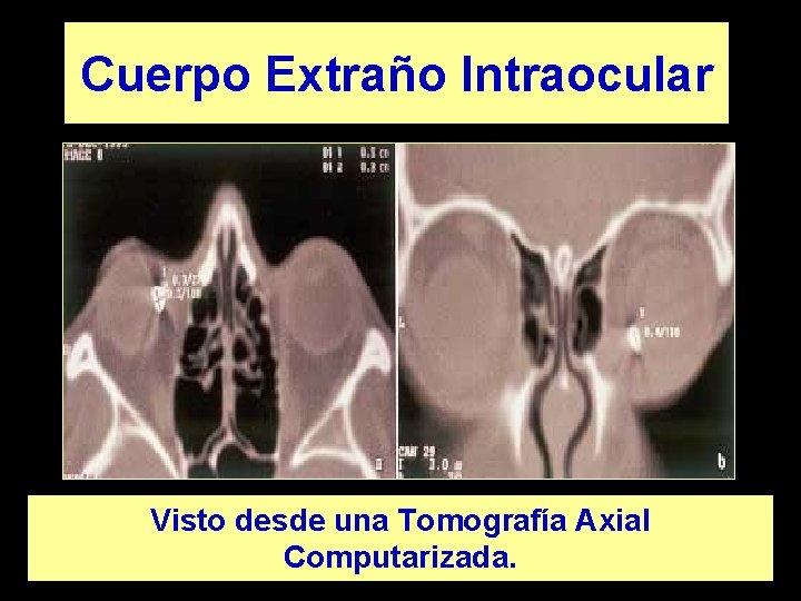 Cuerpo Extraño Intraocular Visto desde una Tomografía Axial Computarizada. 