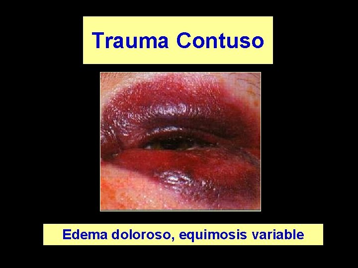 Trauma Contuso Edema doloroso, equimosis variable 