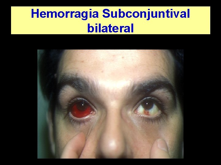 Hemorragia Subconjuntival bilateral 