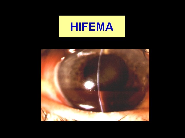 HIFEMA 