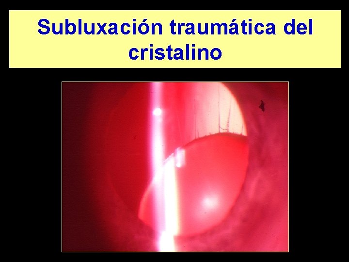 Subluxación traumática del cristalino 
