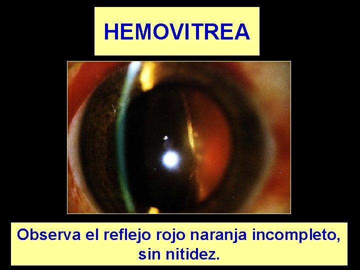 HEMOVITREA Observa el reflejo rojo naranja incompleto, sin nitidez. 
