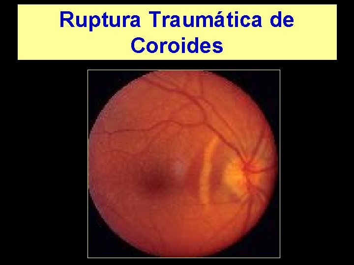 Ruptura Traumática de Coroides 