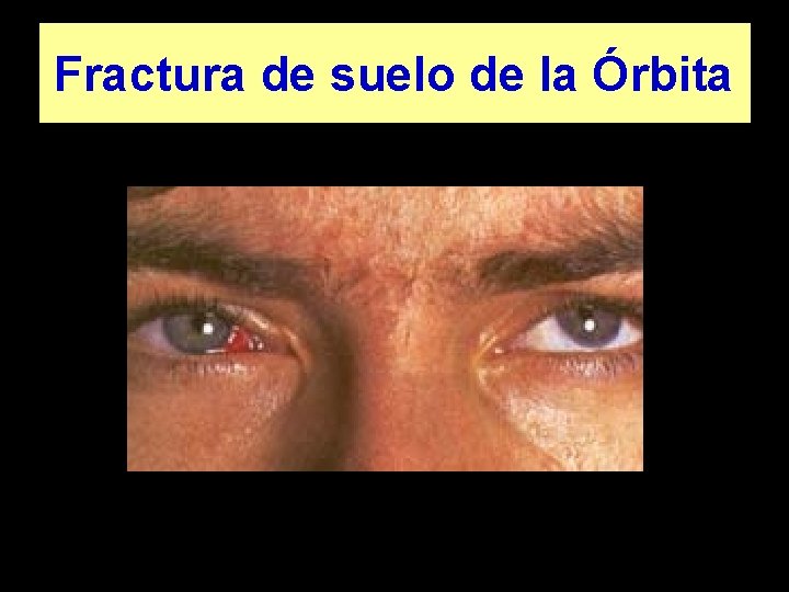 Fractura de suelo de la Órbita 