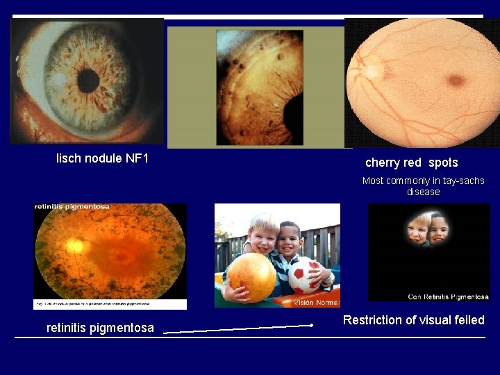 lisch nodule NF 1 cherry red spots Most commonly in tay-sachs disease retinitis pigmentosa