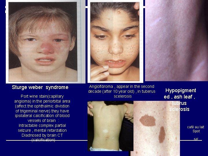 Sturge weber syndrome Port wine stain(capillary angioma) in the periorbital area (affect the ophthalmic