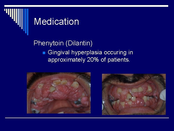 Medication Phenytoin (Dilantin) n Gingival hyperplasia occuring in approximately 20% of patients. 