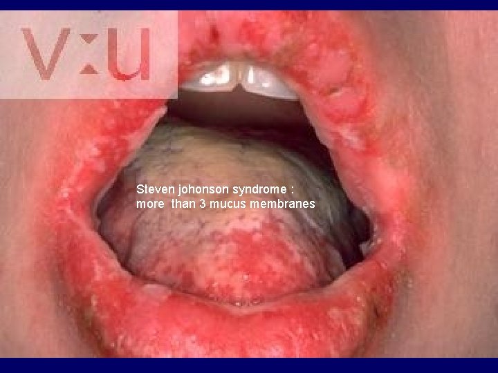 Steven johonson syndrome : more than 3 mucus membranes 