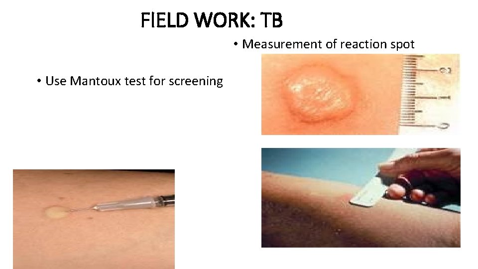 FIELD WORK: TB • Measurement of reaction spot • Use Mantoux test for screening