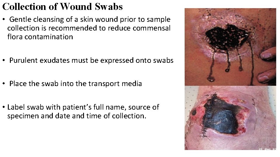 Collection of Wound Swabs • Gentle cleansing of a skin wound prior to sample