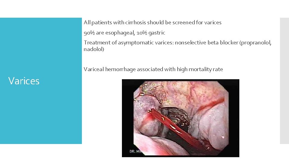 All patients with cirrhosis should be screened for varices 90% are esophageal, 10% gastric