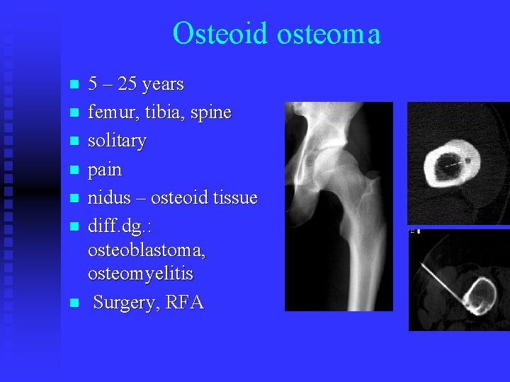 Osteoid osteoma n n n n 5 – 25 years femur, tibia, spine solitary