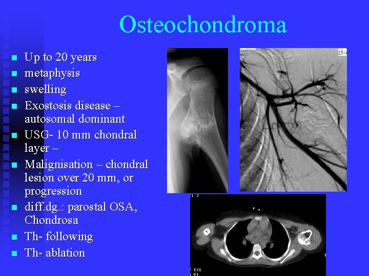 Osteochondroma n n n n n Up to 20 years metaphysis swelling Exostosis disease