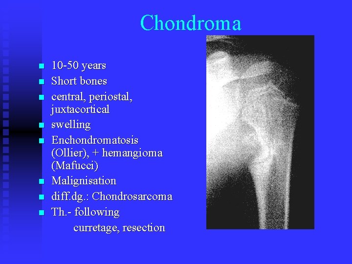 Chondroma n n n n 10 -50 years Short bones central, periostal, juxtacortical swelling