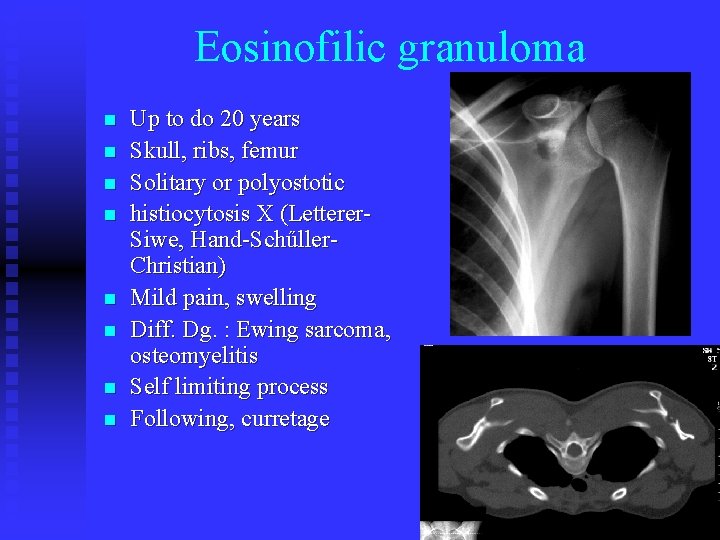 Eosinofilic granuloma n n n n Up to do 20 years Skull, ribs, femur