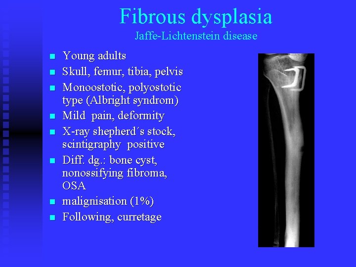 Fibrous dysplasia Jaffe-Lichtenstein disease n n n n Young adults Skull, femur, tibia, pelvis