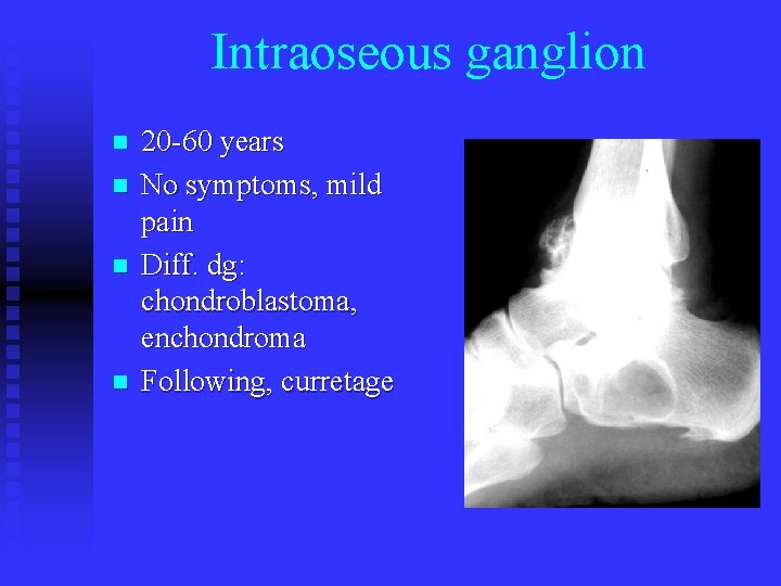 Intraoseous ganglion n n 20 -60 years No symptoms, mild pain Diff. dg: chondroblastoma,