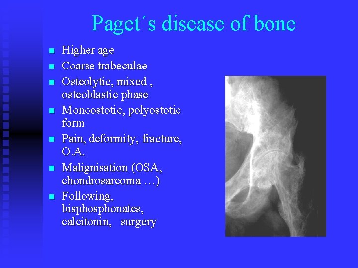 Paget´s disease of bone n n n n Higher age Coarse trabeculae Osteolytic, mixed