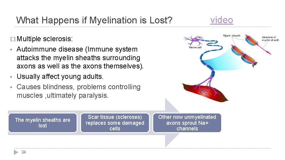 What Happens if Myelination is Lost? video � Multiple • • • sclerosis: Autoimmune