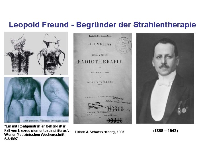 Leopold Freund - Begründer Strahlentherapie "Ein mit Röntgenstrahlen behandelter Fall von Naevus pigmentosus piliferus",