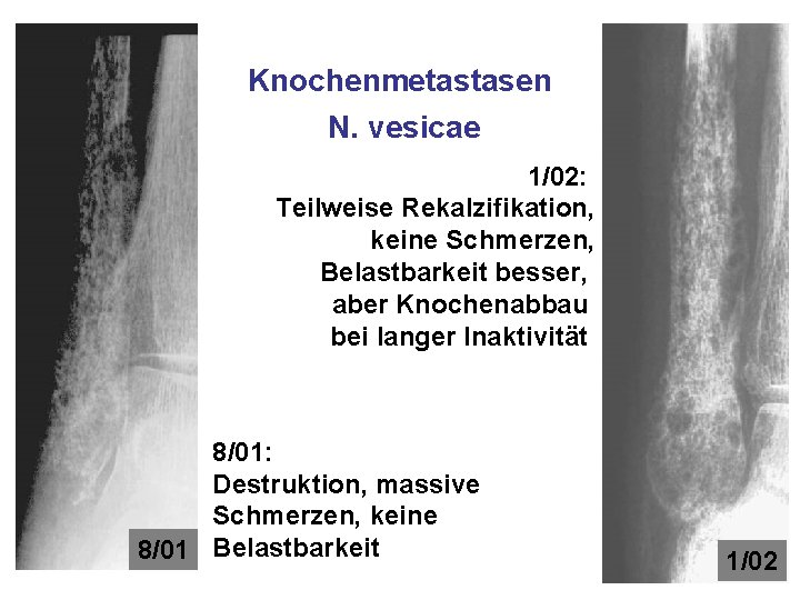 Knochenmetastasen N. vesicae 1/02: Teilweise Rekalzifikation, keine Schmerzen, Belastbarkeit besser, aber Knochenabbau bei langer