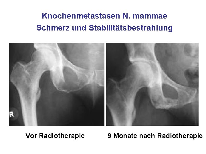 Knochenmetastasen N. mammae Schmerz und Stabilitätsbestrahlung Vor Radiotherapie 9 Monate nach Radiotherapie 