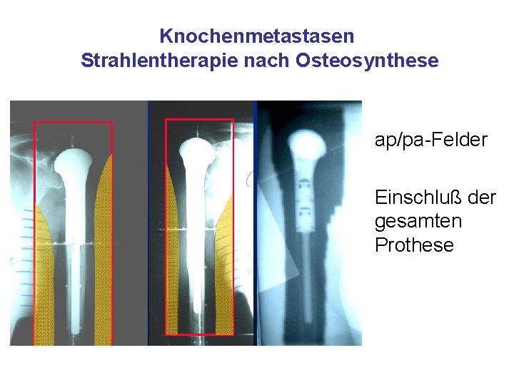 Knochenmetastasen Strahlentherapie nach Osteosynthese ap/pa-Felder Einschluß der gesamten Prothese 