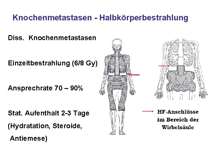 Knochenmetastasen - Halbkörperbestrahlung Diss. Knochenmetastasen Einzeitbestrahlung (6/8 Gy) Ansprechrate 70 – 90% Stat. Aufenthalt