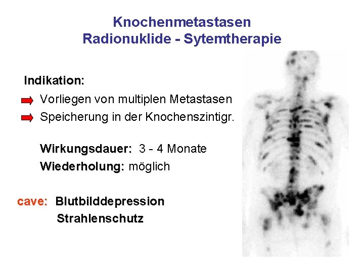 Knochenmetastasen Radionuklide - Sytemtherapie Indikation: Vorliegen von multiplen Metastasen Speicherung in der Knochenszintigr. Wirkungsdauer: