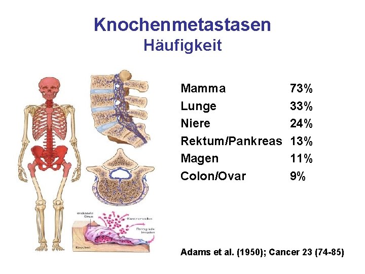 Knochenmetastasen Häufigkeit Mamma Lunge Niere Rektum/Pankreas Magen Colon/Ovar 73% 33% 24% 13% 11% 9%