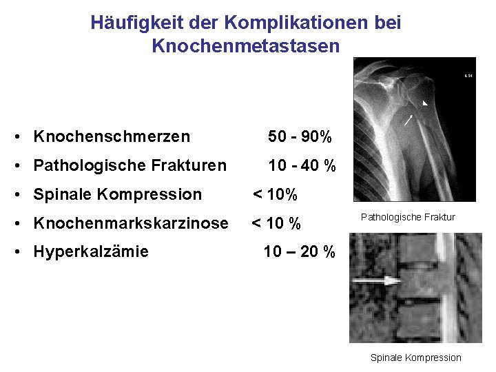 Häufigkeit der Komplikationen bei Knochenmetastasen • Knochenschmerzen 50 - 90% • Pathologische Frakturen 10