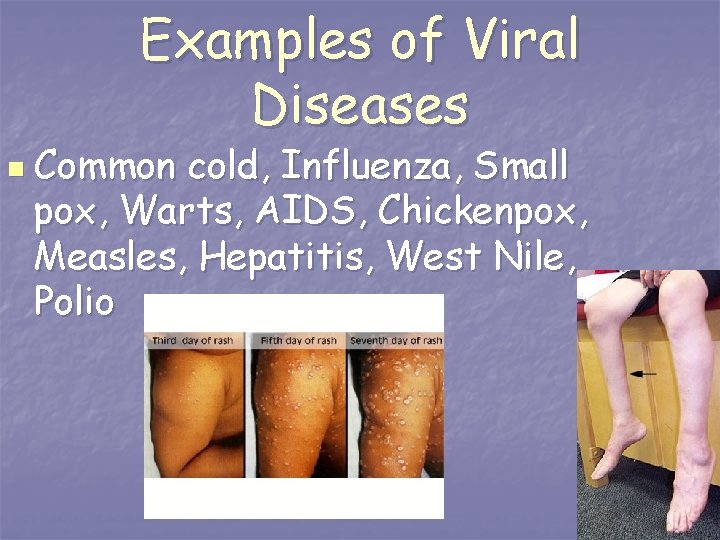 Examples of Viral Diseases n Common cold, Influenza, Small pox, Warts, AIDS, Chickenpox, Measles,