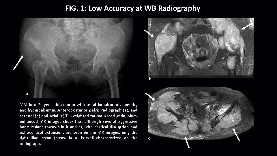 FIG. 1: Low Accuracy at WB Radiography b. a. MM in a 71 -year-old