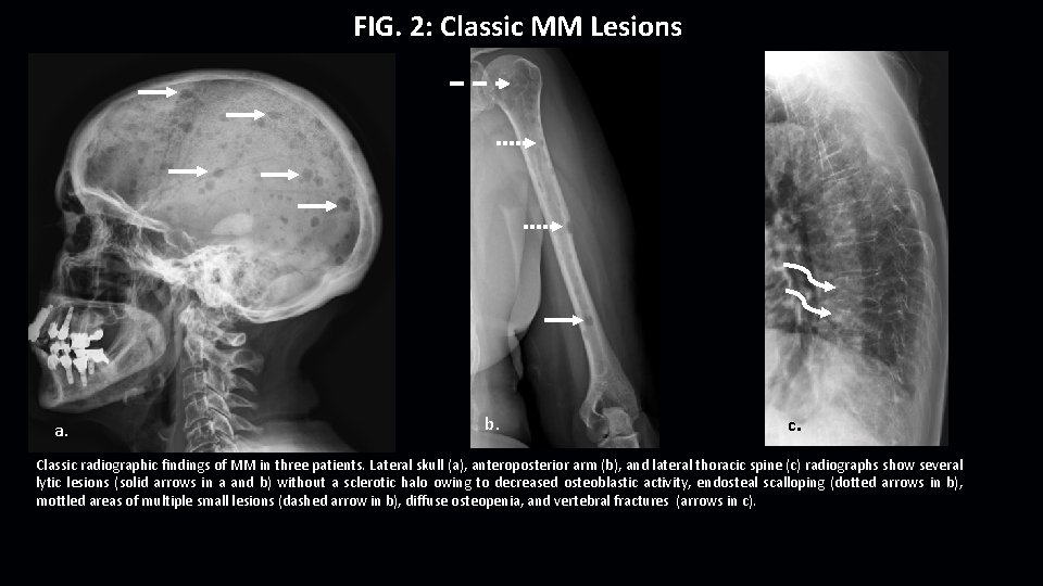 FIG. 2: Classic MM Lesions a. b. c. Classic radiographic findings of MM in